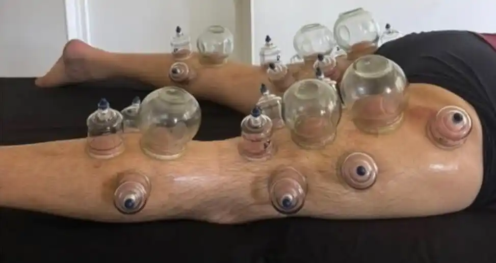 Précautions et contre-indications du cupping