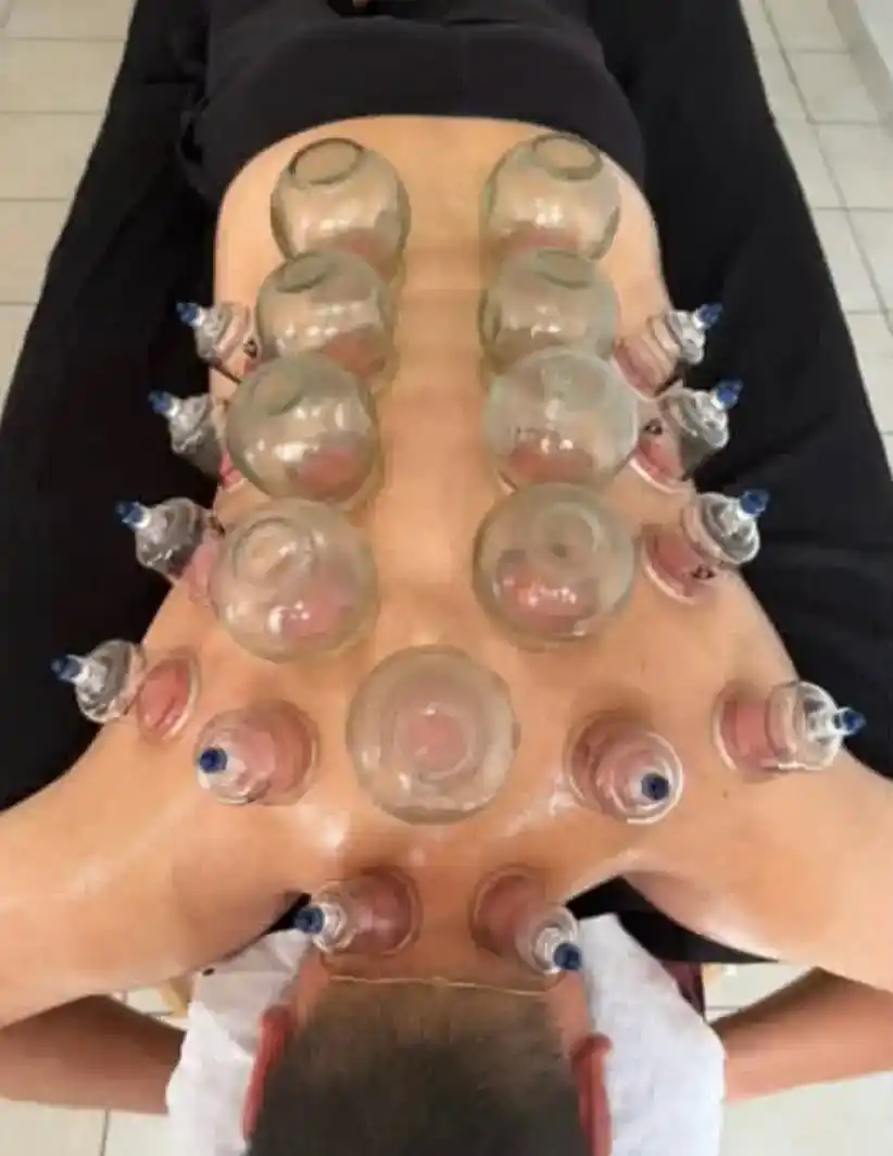 Séance de cupping à Geispolsheim près de Strasbourg